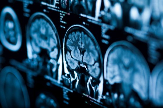 MRT-Bilder vom Gehirn zur Diagnostik der Enzephalopathie