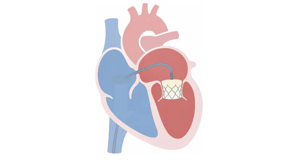 Illustration eines menschlichen Herzens mit kathetergestützter Mitralklappenprothese (TMVR) in situ, dargestellt in einer vereinfachten anatomischen Schnittansicht
