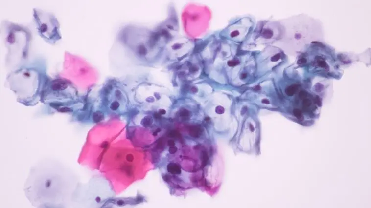 Zytologischer Abstrich mit atypischen Tumorzellen bei Zervixkarzinom.
