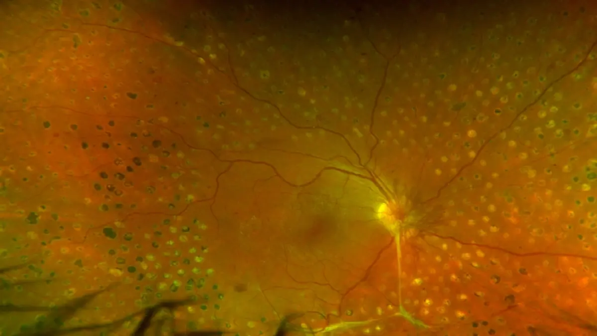 Panretinale Laserung konventionell